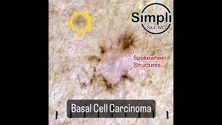 Basal Cell Carcinoma Dermoscopy [upl. by Oninotna541]