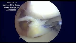 meniscotibial repair mute [upl. by Janicki]