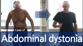 Abdominal wall dystonia  Truncal dystonia  Belly dancer’s dyskinesia  전신 사경증  근긴장이상증 [upl. by Chaney966]