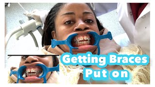 Direct procedure of getting braces on Overbite amp openbite correction details [upl. by Llehsad287]