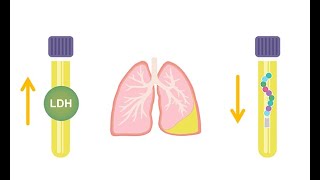 Differentiating transudative and exudative effusions transudate vs exudate [upl. by Lekym]