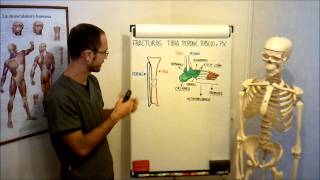 umh1729 201213 Lec018 Fracturas tibia peroné tobillo y pie [upl. by Nosnej]