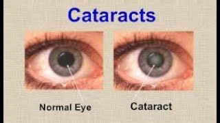 Best Homeopathic products for reducing Cateract problems [upl. by Carita]