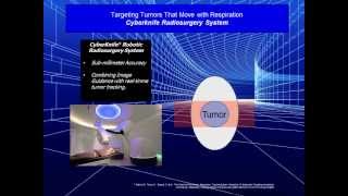 Moving Tumor Targeting Methods Outlined  CyberKnife vs Gating and Breathholds  IMRTIGRT [upl. by Kred608]