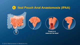 Small Bowel and Large Bowel Surgery [upl. by Sucramed453]