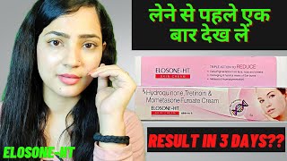 Elosone HT cream review Uses  Elosone HT Benifits and side effects [upl. by Maurili]