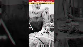 Laparoscopic Cystectomy Procedure by Dr Rakshita Malik doctor gynaecologist ivfspecialist mbbs [upl. by Zuleika]