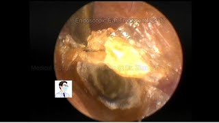 Ear wax removal Cleaning of fungal rolls 20230417 [upl. by Ymassej]