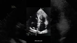 Aneurysmal apex 💔 echocardiogram echocardiography cardiology heartscan Aneurysm [upl. by Foote]