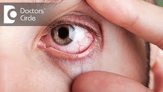 What causes visible red fine lines in eyes  Dr Elankumaran P [upl. by Gabrielli]