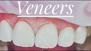 emax veneers by minimal prep veneers [upl. by Benedict802]