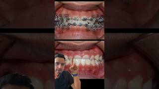 Cas ORTHODONTIE  l’INVERSÉ d’occlusion DENTAIRE [upl. by Nevs]