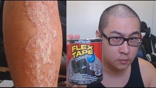 Is FLEX TAPE strong enough for Psoriasis Flakes [upl. by Benedicta]