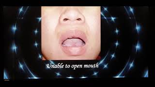 Acute salivary gland infection Patient teaching programme Malayalam [upl. by Sehcaep]