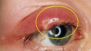 how to get rid of a chalazion with apple cider vinegar [upl. by Betsey674]