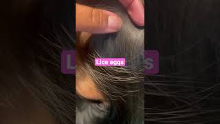 What Nits Look Like On Dry Hair l Lice Removal Service staceythelouselady [upl. by Cherlyn]