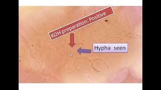 KOH positive  Fungal elements seen  Sputum  hyphae [upl. by Kotz]