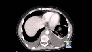 CT Chest ADENOPATHY Discussion [upl. by Cathey]