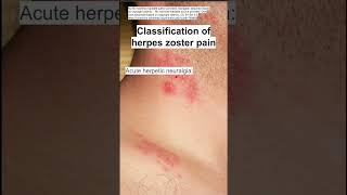 Classification of herpes zoster shingles pain [upl. by Odel]