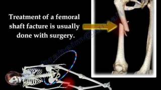 Fracture of the Femur and its fixation  Everything You Need To Know  Dr Nabil Ebraheim [upl. by Airdnna]