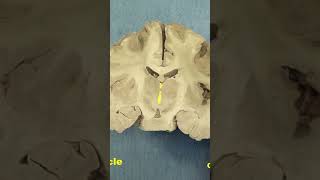 Caudal diencephalon Thalamus and subthalamusneuroanatomy forebrain anatomy brainhumanbrain [upl. by Ytsirk957]