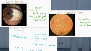 XEROPHTHALMIA  Vitamin A deficiency  ophthalmology  English  symptoms  treatment [upl. by Teague]