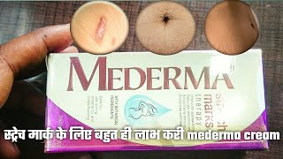 Mederma Stretch Marks Therapy Review in Hindi MEDERMA STRETCH MARK THERAPY स्ट्रेच मार्क्स का ईलाज [upl. by Nedi353]