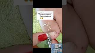 Ouch Two deep toenail cutting nail​​​ asmr fyp ear shorts viral wax [upl. by Notnirb26]