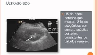 Litiasis Renal  Parte 3 [upl. by Yatzeck899]