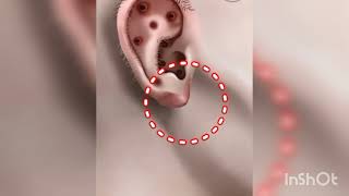 ASMR Treatment and remove for Piercingfor swollen girls ear ear piercing  ASMR video [upl. by Sal]