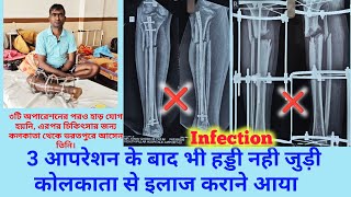 tibia fibula and femur fracture ilizarov surgery fail kolkata se bharatpur ilaaj ke liye aaya [upl. by Brannon131]