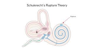 Menieres Disease A New Theory [upl. by Wells]