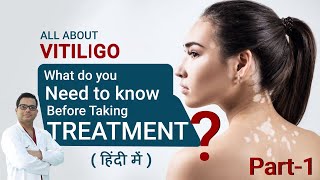 All About Vitiligo  Leucoderma  White patches PART1  Treatment options  Dr Jangid MD Skin [upl. by Imyaj470]