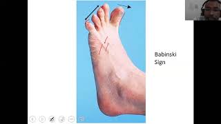 Babinski Sign Normal and Abnormal Plantar reflexNeuroPhysiology CNS PhysiologyLecturesForMBBS [upl. by Tiernan12]