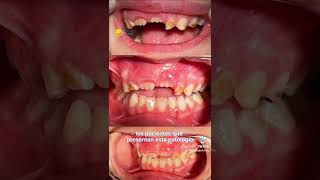 HIPOPLASIA DENTAL  manchas blancas en los dientes [upl. by Burnley]