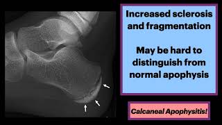 Calcaneal Apophysitis MSK Radiology Orthopedics [upl. by Jordain430]