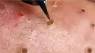 Full Giant Blackheads Popping Video Blackheads Removal 2019 [upl. by Buyse]