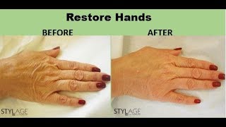 how to get younger looking hands with Stylage Hydromax Skin Booster [upl. by Atinek]