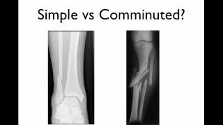 How to describe a fracture [upl. by Celinda]