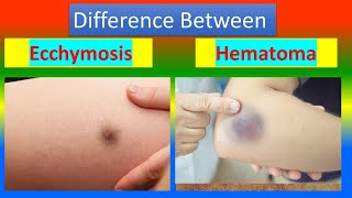 Difference between Ecchymosis and Hematoma [upl. by Dyson402]