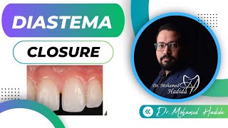 Diastema Closure  Dr Mohamed Hadida [upl. by Leinnad]