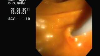 CPRE y drenaje de Colangitis Aguda ERCP acute cholangitis [upl. by Ottinger]