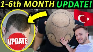 Subscribers 1 to 6 Months Post Op Progress  5000 Grafts Hair Transplant in Turkey  HLC [upl. by Eedahs]