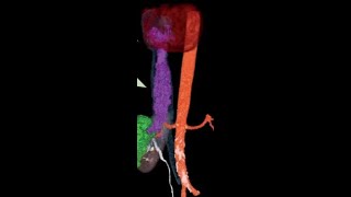 IVC leiomyosarcoma [upl. by Bronnie980]