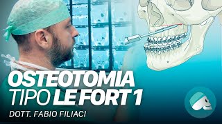 Chirurgia ortognatica  Osteotomia tipo Le Fort I [upl. by Auoh]