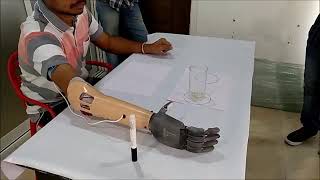 Myoelectric prosthetic hand fitment trial [upl. by Yrebmik]