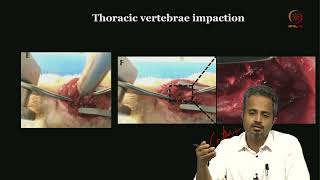 Lec 35 Spinal micro neuro Surgery [upl. by Kcinnay]