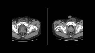 Scrotal Liposarcoma [upl. by Budde]