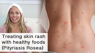 Treating skin rash and inflammation with healthy foods Pityriasis Rosea [upl. by Joby]