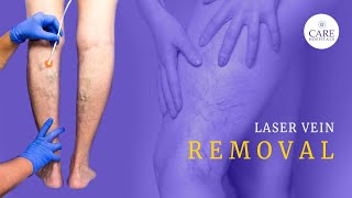 Laser Vein Removal  Treatment for Varicose Veins  CARE Hospitals [upl. by Casimire826]